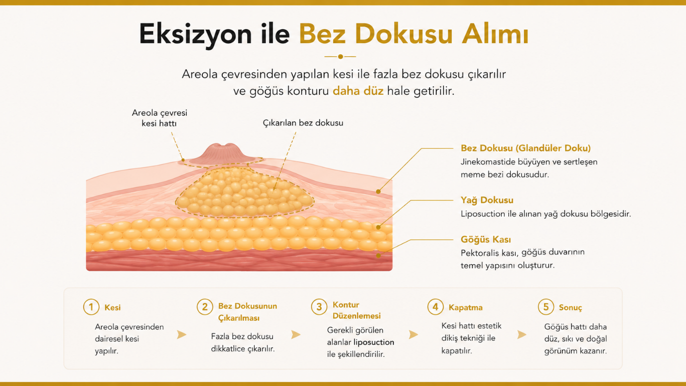 Eksizyon yöntemiyle jinekomasti ameliyatı