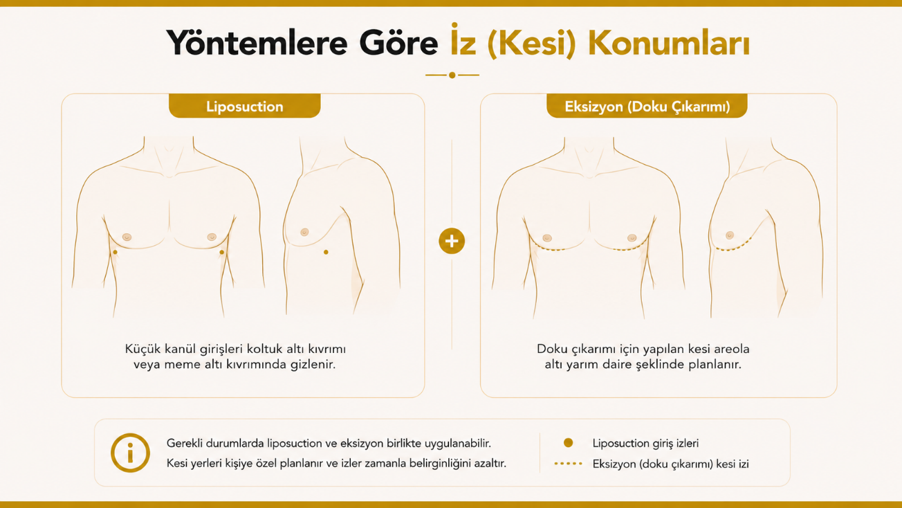 Jinekomasti ameliyatında iz kalır mı